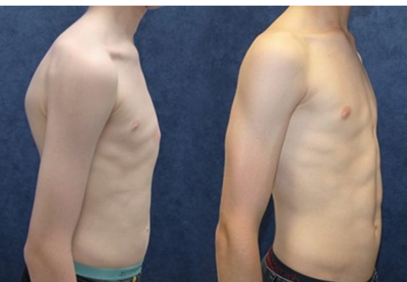 What is Pectus Carinatum?   